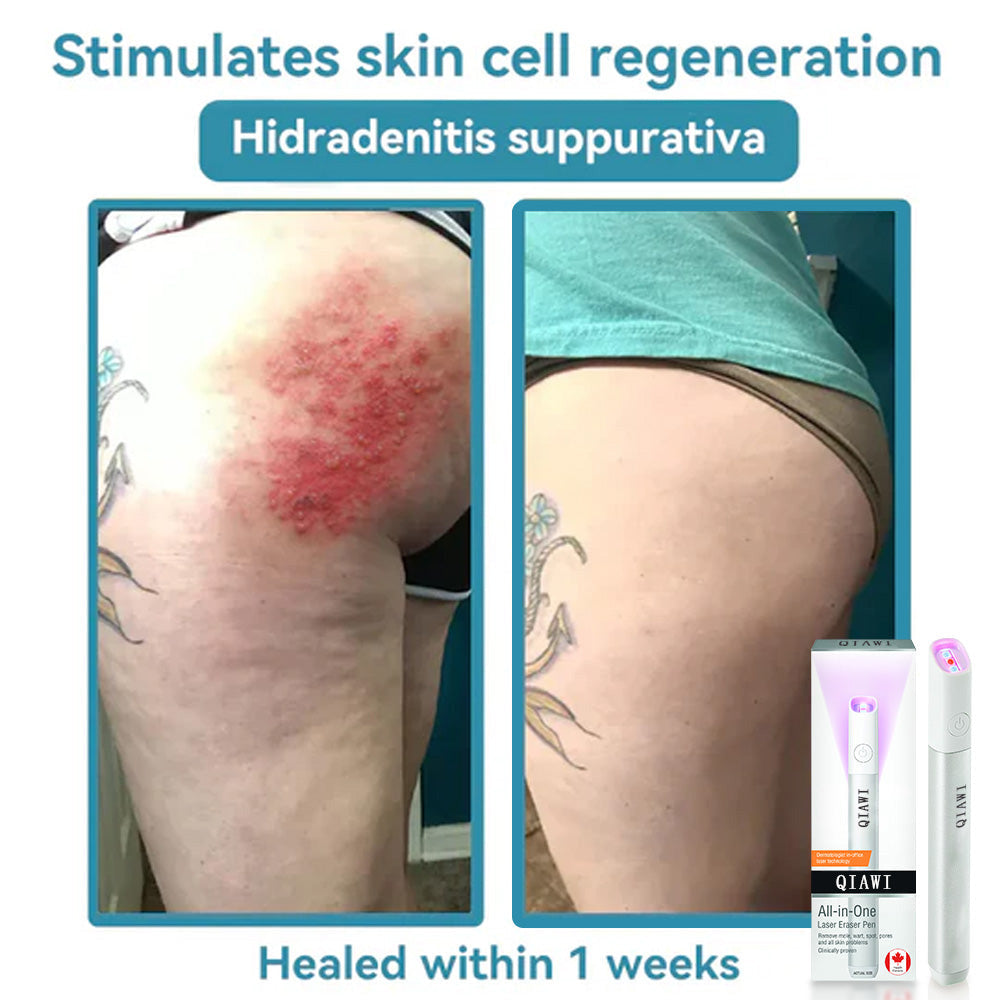 QIAWI™ CO₂ Laser Pen: Erase Skin Imperfections Fast & Safely ✨